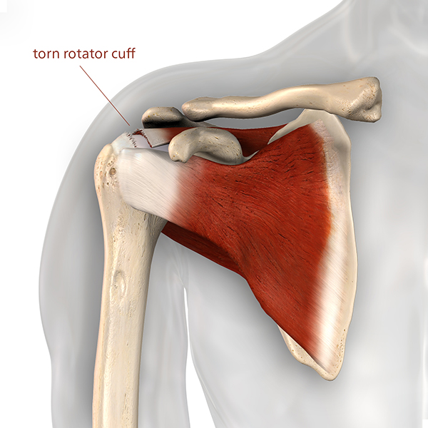 Is Your Shoulder Pain Coming From The Rotator Cuff? -Innovative PT